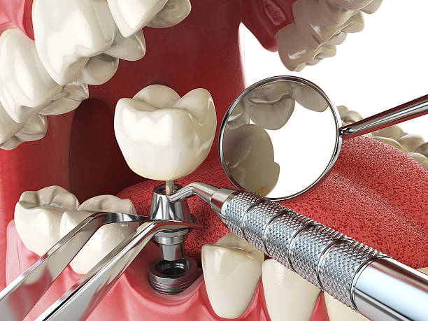 Best Root Canal Emergency Dentist  in Jefferson, GA